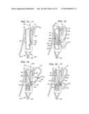 Transesophageal gastric reduction method and device for reducing the size of a previously formed gastric reduction pouch diagram and image