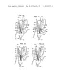 Transesophageal gastric reduction method and device for reducing the size of a previously formed gastric reduction pouch diagram and image