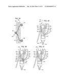 Transesophageal gastric reduction method and device for reducing the size of a previously formed gastric reduction pouch diagram and image