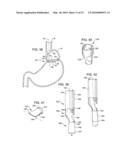 Transesophageal gastric reduction method and device for reducing the size of a previously formed gastric reduction pouch diagram and image