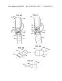 Transesophageal gastric reduction method and device for reducing the size of a previously formed gastric reduction pouch diagram and image