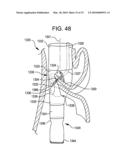 Transesophageal gastric reduction method and device for reducing the size of a previously formed gastric reduction pouch diagram and image