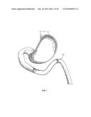 ANASTOMOTIC DEVICE diagram and image