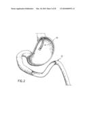 ANASTOMOTIC DEVICE diagram and image