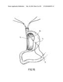 ANASTOMOTIC DEVICE diagram and image