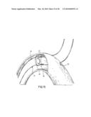 ANASTOMOTIC DEVICE diagram and image