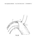 ANASTOMOTIC DEVICE diagram and image