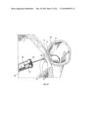 ANASTOMOTIC DEVICE diagram and image