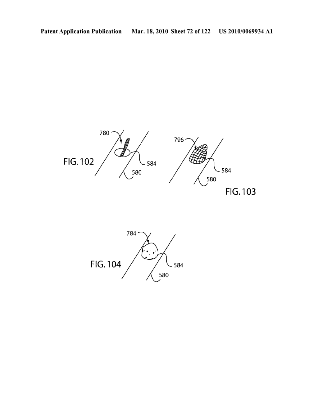 Anastomosis Method Utilizing Tool with Fluid-Driven Actuator - diagram, schematic, and image 73