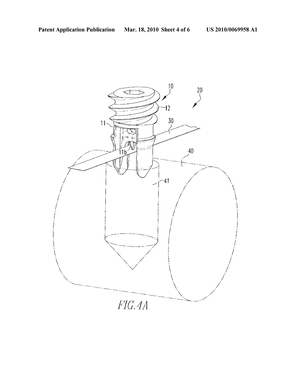 Tenodesis Implant - diagram, schematic, and image 05