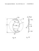 Intraocular Lens diagram and image