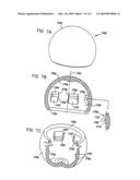 Foldable Prosthetic Implant Element diagram and image