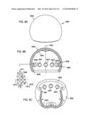 Foldable Prosthetic Implant Element diagram and image