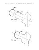 Foldable Prosthetic Implant Element diagram and image