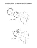 Foldable Prosthetic Implant Element diagram and image