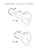 Foldable Prosthetic Implant Element diagram and image