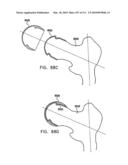 Foldable Prosthetic Implant Element diagram and image