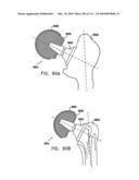 Foldable Prosthetic Implant Element diagram and image