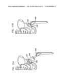 Foldable Prosthetic Implant Element diagram and image