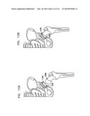 Foldable Prosthetic Implant Element diagram and image