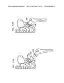 Foldable Prosthetic Implant Element diagram and image