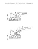 Foldable Prosthetic Implant Element diagram and image