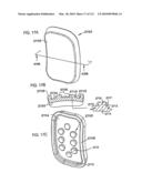 Foldable Prosthetic Implant Element diagram and image