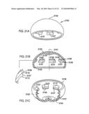 Foldable Prosthetic Implant Element diagram and image