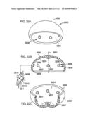 Foldable Prosthetic Implant Element diagram and image