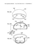 Foldable Prosthetic Implant Element diagram and image