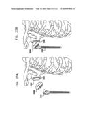 Foldable Prosthetic Implant Element diagram and image