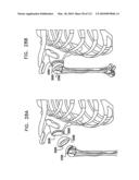 Foldable Prosthetic Implant Element diagram and image