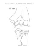 Foldable Prosthetic Implant Element diagram and image