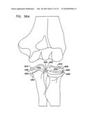 Foldable Prosthetic Implant Element diagram and image