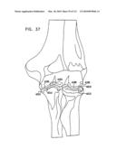 Foldable Prosthetic Implant Element diagram and image