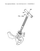 Foldable Prosthetic Implant Element diagram and image