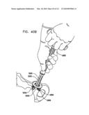 Foldable Prosthetic Implant Element diagram and image