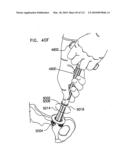 Foldable Prosthetic Implant Element diagram and image