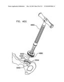 Foldable Prosthetic Implant Element diagram and image