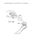 Foldable Prosthetic Implant Element diagram and image