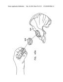 Foldable Prosthetic Implant Element diagram and image