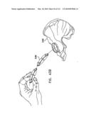 Foldable Prosthetic Implant Element diagram and image