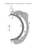 Foldable Prosthetic Implant Element diagram and image