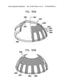 Foldable Prosthetic Implant Element diagram and image