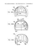 Foldable Prosthetic Implant Element diagram and image