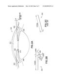 Device for Use in a Surgical Procedure on a Human Eye diagram and image