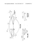 Device for Use in a Surgical Procedure on a Human Eye diagram and image