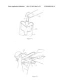 SPECULUM diagram and image