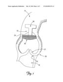 SURGICAL TOOL FOR VASCULAR EXPOSURE AND ACCESS diagram and image