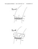 SURGICAL TOOL FOR VASCULAR EXPOSURE AND ACCESS diagram and image